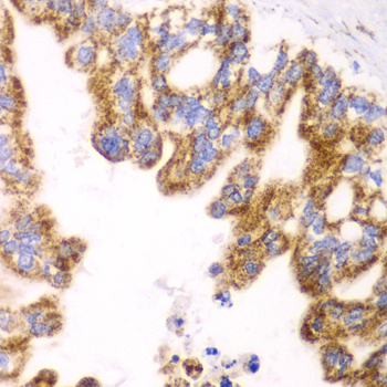 GLUD2 Antibody - Immunohistochemistry of paraffin-embedded human liver cancer tissue.