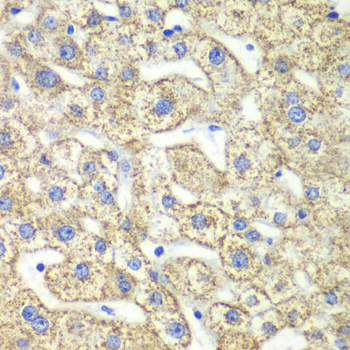 GLUD2 Antibody - Immunohistochemistry of paraffin-embedded human liver injury tissue.