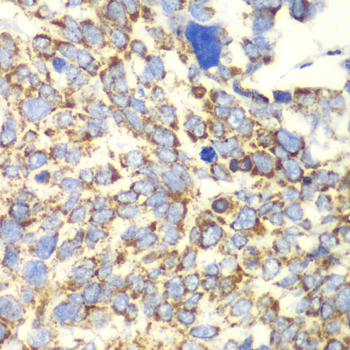 GLUD2 Antibody - Immunohistochemistry of paraffin-embedded human esophageal cancer tissue.
