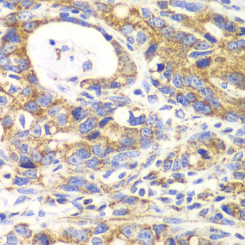 GLUD2 Antibody - Immunohistochemistry of paraffin-embedded human gastric cancer tissue.