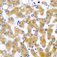 GLUD2 Antibody - Immunohistochemical analysis of GLUD2 staining in human liver cancer formalin fixed paraffin embedded tissue section. The section was pre-treated using heat mediated antigen retrieval with sodium citrate buffer (pH 6.0). The section was then incubated with the antibody at room temperature and detected using an HRP conjugated compact polymer system. DAB was used as the chromogen. The section was then counterstained with hematoxylin and mounted with DPX.