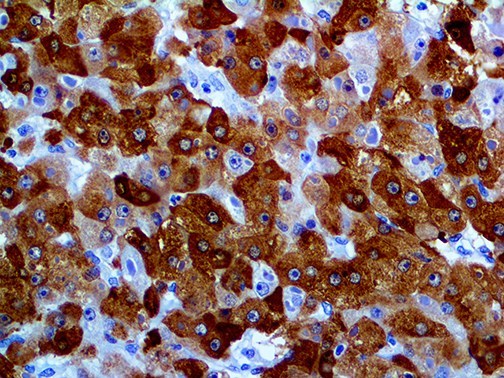GLUL / Glutamine Synthetase Antibody - IHC of Glutamine Synthetase on an FFPE Hepatocellular Carcinoma Tissue