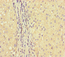 GLUL / Glutamine Synthetase Antibody - Immunohistochemistry of paraffin-embedded human liver cancer at dilution of 1:100