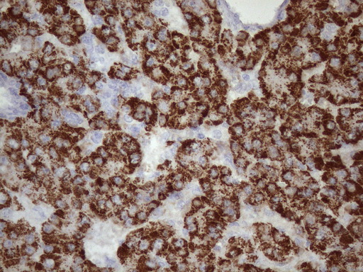 GLYAT Antibody - Immunohistochemical staining of paraffin-embedded Carcinoma of Human liver tissue using anti-GLYAT mouse monoclonal antibody. (Heat-induced epitope retrieval by 1mM EDTA in 10mM Tris buffer. (pH8.5) at 120 oC for 3 min. (1:150)