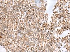 GLYAT Antibody - Immunohistochemistry of paraffin-embedded Human ovarian cancer tissue  using GLYAT Polyclonal Antibody at dilution of 1:50(×200)