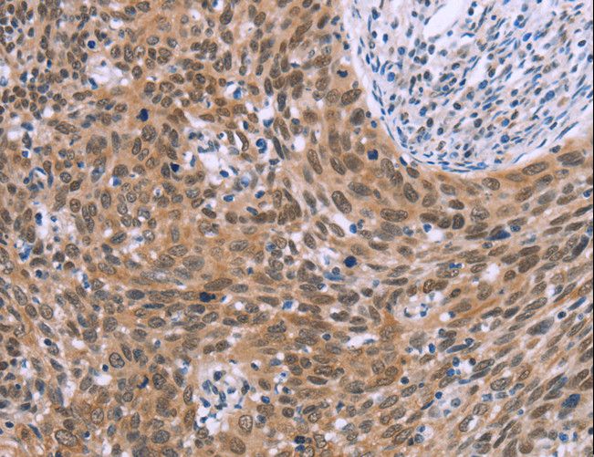GLYR1 Antibody - Immunohistochemistry of paraffin-embedded Human liver cancer using GLYR1 Polyclonal Antibody at dilution of 1:30.