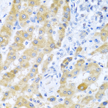Gm13125 Antibody - Immunohistochemistry of paraffin-embedded human liver cancer tissue.