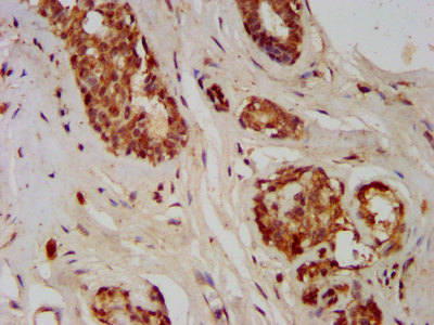GMDS / GMD Antibody - Immunohistochemistry image at a dilution of 1:400 and staining in paraffin-embedded human breast cancer performed on a Leica BondTM system. After dewaxing and hydration, antigen retrieval was mediated by high pressure in a citrate buffer (pH 6.0) . Section was blocked with 10% normal goat serum 30min at RT. Then primary antibody (1% BSA) was incubated at 4 °C overnight. The primary is detected by a biotinylated secondary antibody and visualized using an HRP conjugated SP system.