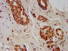GMDS / GMD Antibody - Immunohistochemistry image at a dilution of 1:400 and staining in paraffin-embedded human breast cancer performed on a Leica BondTM system. After dewaxing and hydration, antigen retrieval was mediated by high pressure in a citrate buffer (pH 6.0) . Section was blocked with 10% normal goat serum 30min at RT. Then primary antibody (1% BSA) was incubated at 4 °C overnight. The primary is detected by a biotinylated secondary antibody and visualized using an HRP conjugated SP system.