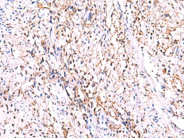 GMDS / GMD Antibody - Immunohistochemistry of paraffin-embedded Human cervical cancer tissue  using GMDS Polyclonal Antibody at dilution of 1:70(×200)