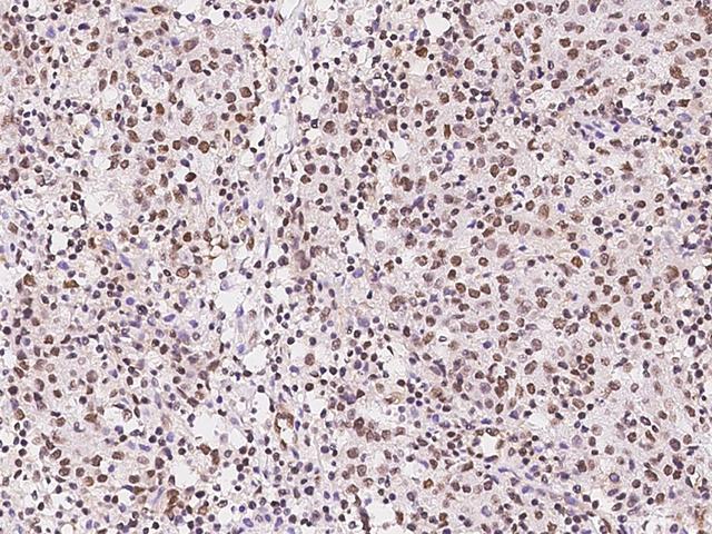 GMEB1 Antibody - Immunochemical staining of human GMEB1 in human lung cancer with rabbit polyclonal antibody at 1:1000 dilution, formalin-fixed paraffin embedded sections.