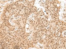 GMEB2 Antibody - Immunohistochemistry of paraffin-embedded Human esophagus cancer tissue  using GMEB2 Polyclonal Antibody at dilution of 1:30(×200)