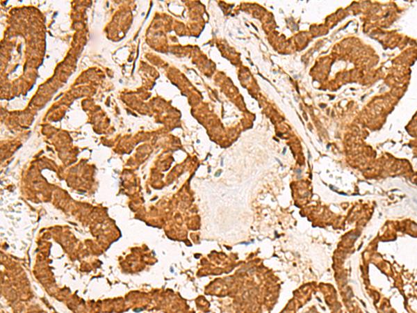 GMEB2 Antibody - Immunohistochemistry of paraffin-embedded Human thyroid cancer tissue  using GMEB2 Polyclonal Antibody at dilution of 1:35(×200)