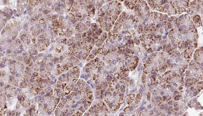 GMF Beta / GMFB Antibody - 1:100 staining human pancreas carcinoma tissue by IHC-P. The sample was formaldehyde fixed and a heat mediated antigen retrieval step in citrate buffer was performed. The sample was then blocked and incubated with the antibody for 1.5 hours at 22°C. An HRP conjugated goat anti-rabbit antibody was used as the secondary.