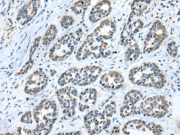 GMF Beta / GMFB Antibody - Immunohistochemistry of paraffin-embedded Human esophagus cancer tissue  using GMFB Polyclonal Antibody at dilution of 1:25(×200)