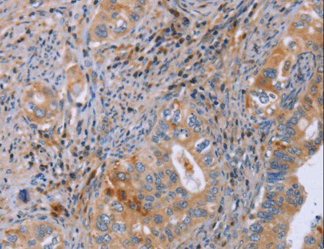 GMFG Antibody - Immunohistochemistry of paraffin-embedded Human cervical cancer using GMFG Polyclonal Antibody at dilution of 1:50.