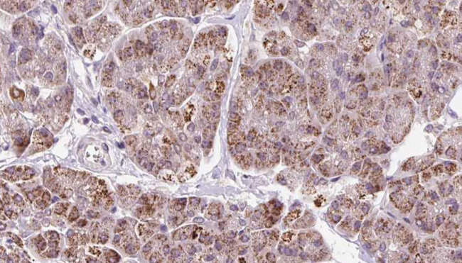 GMFG Antibody - 1:100 staining human pancreas carcinoma tissue by IHC-P. The sample was formaldehyde fixed and a heat mediated antigen retrieval step in citrate buffer was performed. The sample was then blocked and incubated with the antibody for 1.5 hours at 22°C. An HRP conjugated goat anti-rabbit antibody was used as the secondary.