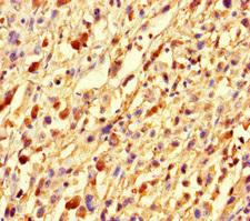 GMIP Antibody - Immunohistochemistry of paraffin-embedded human melanoma cancer at dilution of 1:100