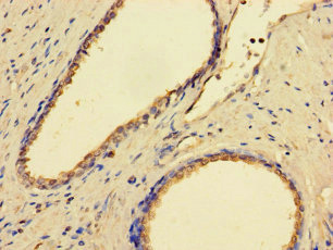 GMPPB Antibody - Immunohistochemistry of paraffin-embedded human prostate cancer using GMPPB Antibody at dilution of 1:100