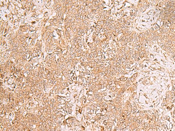 GMPPB Antibody - Immunohistochemistry of paraffin-embedded Human ovarian cancer tissue  using GMPPB Polyclonal Antibody at dilution of 1:50(×200)
