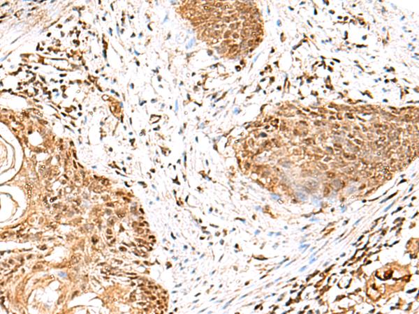 GMPPB Antibody - Immunohistochemistry of paraffin-embedded Human esophagus cancer tissue  using GMPPB Polyclonal Antibody at dilution of 1:50(×200)