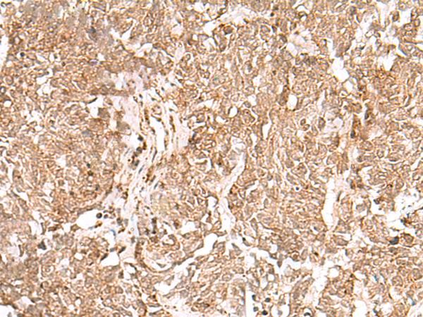 GMPPB Antibody - Immunohistochemistry of paraffin-embedded Human lung cancer tissue  using GMPPB Polyclonal Antibody at dilution of 1:50(×200)