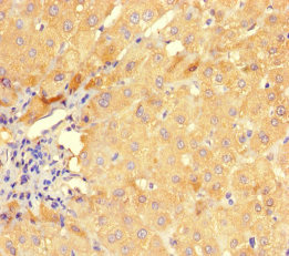 GMPR1 / GMPR Antibody - Immunohistochemistry of paraffin-embedded human liver cancer using GMPR Antibody at dilution of 1:100