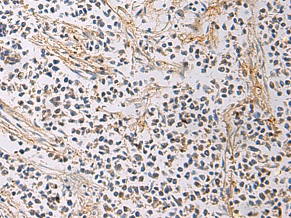 GMPR1 / GMPR Antibody - Immunohistochemistry of paraffin-embedded Human breast cancer tissue  using GMPR Polyclonal Antibody at dilution of 1:60(×200)