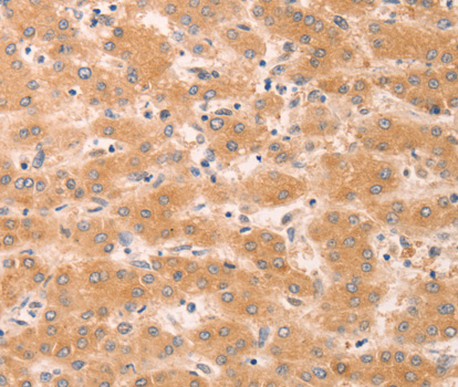 GNA11 Antibody - Immunohistochemistry of paraffin-embedded human liver cancer tissue, using GNA11 antibody.