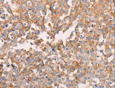 GNA11 Antibody - Immunohistochemistry of paraffin-embedded Human breast cancer using GNA11 Polyclonal Antibody at dilution of 1:40.
