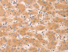 GNA11 Antibody - Immunohistochemistry of paraffin-embedded Human liver cancer using GNA11 Polyclonal Antibody at dilution of 1:40.