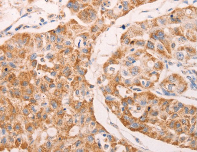 GNA11 Antibody - Immunohistochemistry of paraffin-embedded Human lung cancer using GNA11 Polyclonal Antibody at dilution of 1:40.