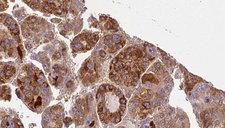 GNA11 Antibody - 1:100 staining human liver carcinoma tissues by IHC-P. The sample was formaldehyde fixed and a heat mediated antigen retrieval step in citrate buffer was performed. The sample was then blocked and incubated with the antibody for 1.5 hours at 22°C. An HRP conjugated goat anti-rabbit antibody was used as the secondary.