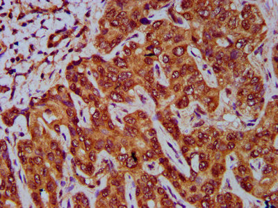 GNA12 Antibody - Immunohistochemistry Dilution at 1:400 and staining in paraffin-embedded human liver cancer performed on a Leica BondTM system. After dewaxing and hydration, antigen retrieval was mediated by high pressure in a citrate buffer (pH 6.0). Section was blocked with 10% normal Goat serum 30min at RT. Then primary antibody (1% BSA) was incubated at 4°C overnight. The primary is detected by a biotinylated Secondary antibody and visualized using an HRP conjugated SP system.