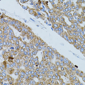 GNA13 Antibody - Immunohistochemistry of paraffin-embedded human liver cancer tissue.