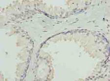 GNA14 Antibody - Immunohistochemistry of paraffin-embedded human prostate cancer using antibody at dilution of 1:100.