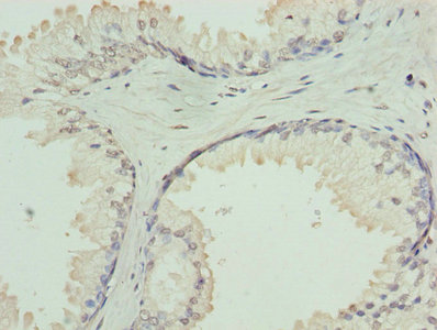 GNA14 Antibody - Immunohistochemistry of paraffin-embedded human prostate cancer using GNA14 Antibody at dilution of 1:100