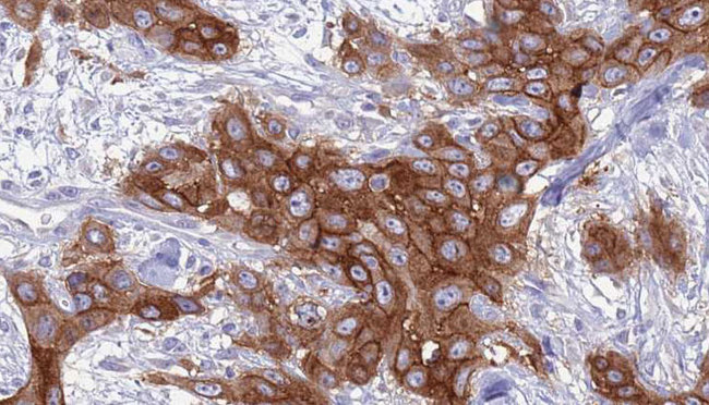 GNA15 Antibody - 1:100 staining human Head and neck carcinoma tissue by IHC-P. The sample was formaldehyde fixed and a heat mediated antigen retrieval step in citrate buffer was performed. The sample was then blocked and incubated with the antibody for 1.5 hours at 22°C. An HRP conjugated goat anti-rabbit antibody was used as the secondary.
