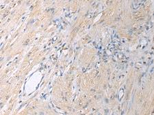 GNAI1 / Gi Antibody - Immunohistochemistry of paraffin-embedded Human gastric cancer tissue  using GNAI1 Polyclonal Antibody at dilution of 1:130(×200)