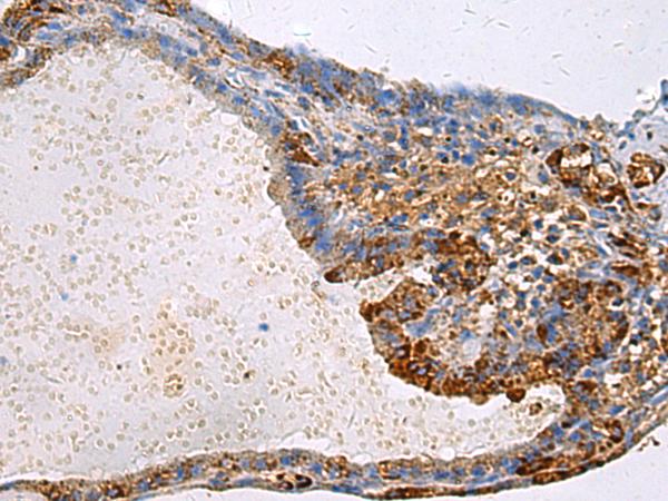 GNAI1 / Gi Antibody - Immunohistochemistry of paraffin-embedded Human thyroid cancer tissue  using GNAI1 Polyclonal Antibody at dilution of 1:100(×200)
