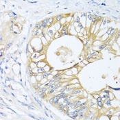 GNAI3 Antibody - Immunohistochemistry of paraffin-embedded human colon carcinoma using GNAI3 antibody at dilution of 1:100 (40x lens).