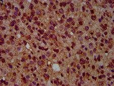 GNAL Antibody - Immunohistochemistry Dilution at 1:500 and staining in paraffin-embedded human glioma cancer performed on a Leica BondTM system. After dewaxing and hydration, antigen retrieval was mediated by high pressure in a citrate buffer (pH 6.0). Section was blocked with 10% normal Goat serum 30min at RT. Then primary antibody (1% BSA) was incubated at 4°C overnight. The primary is detected by a biotinylated Secondary antibody and visualized using an HRP conjugated SP system.