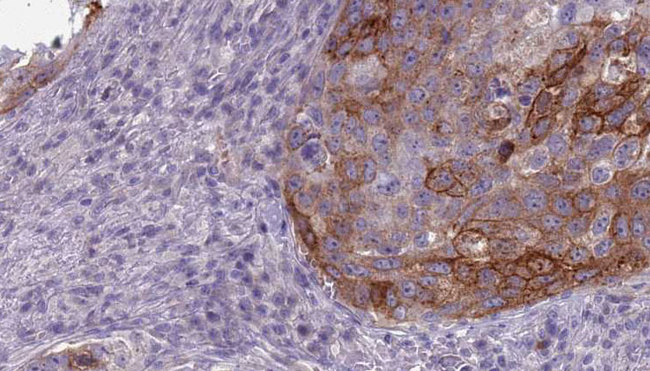 GNAL Antibody - 1:100 staining human urothelial carcinoma tissue by IHC-P. The sample was formaldehyde fixed and a heat mediated antigen retrieval step in citrate buffer was performed. The sample was then blocked and incubated with the antibody for 1.5 hours at 22°C. An HRP conjugated goat anti-rabbit antibody was used as the secondary.