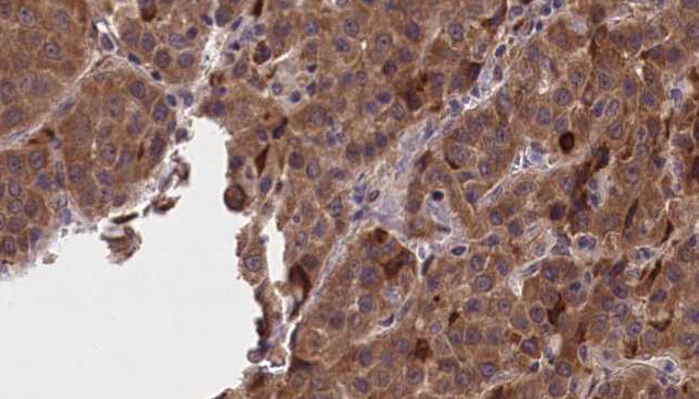 GNAO1 Antibody - 1:100 staining human liver carcinoma tissues by IHC-P. The sample was formaldehyde fixed and a heat mediated antigen retrieval step in citrate buffer was performed. The sample was then blocked and incubated with the antibody for 1.5 hours at 22°C. An HRP conjugated goat anti-rabbit antibody was used as the secondary.