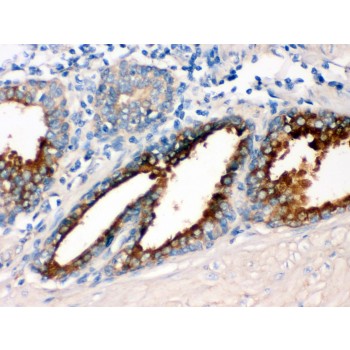 GNAQ Antibody - GNAQ antibody IHC-paraffin. IHC(P): Human Prostatic Cancer Tissue.