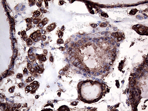 GNAS Antibody - Immunohistochemical staining of paraffin-embedded Carcinoma of Human thyroid tissue using anti-GNAS mouse monoclonal antibody. (Heat-induced epitope retrieval by 1mM EDTA in 10mM Tris buffer. (pH8.5) at 120°C for 3 min. (1:2000)