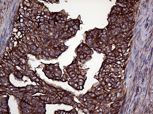 GNAS Antibody - Immunohistochemical staining of paraffin-embedded Adenocarcinoma of Human endometrium tissue using anti-GNAS mouse monoclonal antibody. (Heat-induced epitope retrieval by 1mM EDTA in 10mM Tris buffer. (pH8.5) at 120°C for 3 min. (1:2000)