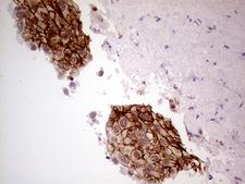 GNAS Antibody - Immunohistochemical staining of paraffin-embedded Carcinoma of Human lung tissue using anti-GNAS mouse monoclonal antibody. (Heat-induced epitope retrieval by 1mM EDTA in 10mM Tris buffer. (pH8.5) at 120°C for 3 min. (1:500)