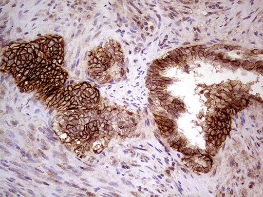 GNAS Antibody - Immunohistochemical staining of paraffin-embedded Adenocarcinoma of Human endometrium tissue using anti-GNAS mouse monoclonal antibody. (Heat-induced epitope retrieval by 1mM EDTA in 10mM Tris buffer. (pH8.5) at 120°C for 3 min. (1:500)