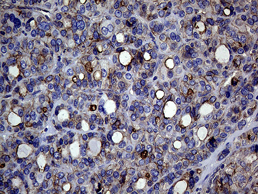 GNAS Antibody - Immunohistochemical staining of paraffin-embedded Carcinoma of Human thyroid tissue using anti-GNAS mouse monoclonal antibody. (Heat-induced epitope retrieval by 1mM EDTA in 10mM Tris buffer. (pH8.5) at 120°C for 3 min. (1:500)